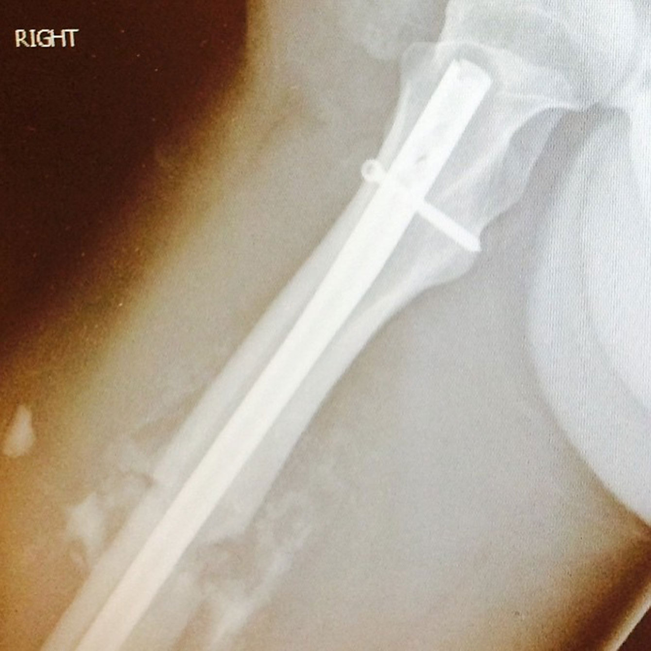 An x-ray image of the metal rod installed to support Denny Morrison's right femur. (Photo: Denny Morrison)